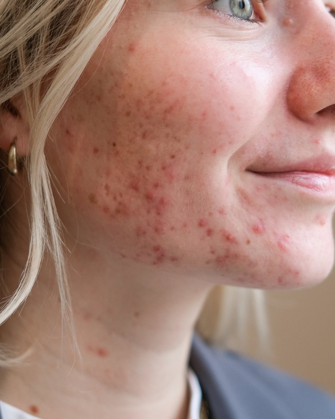 Akne / Unreine Haut